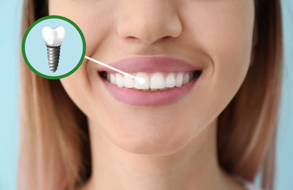 Dental Implants vs Dentures: Uncovering the Best Tooth Replacement Option in Sacramento